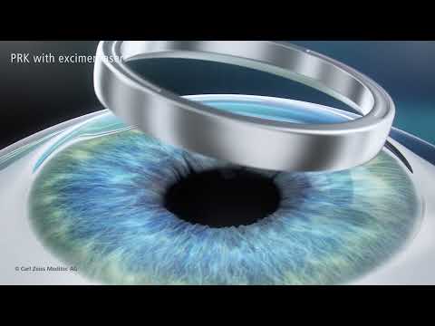 Surface Ablation (PRK)