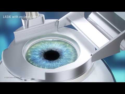 Conventional LASIK