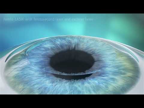 Femto Second LASIK